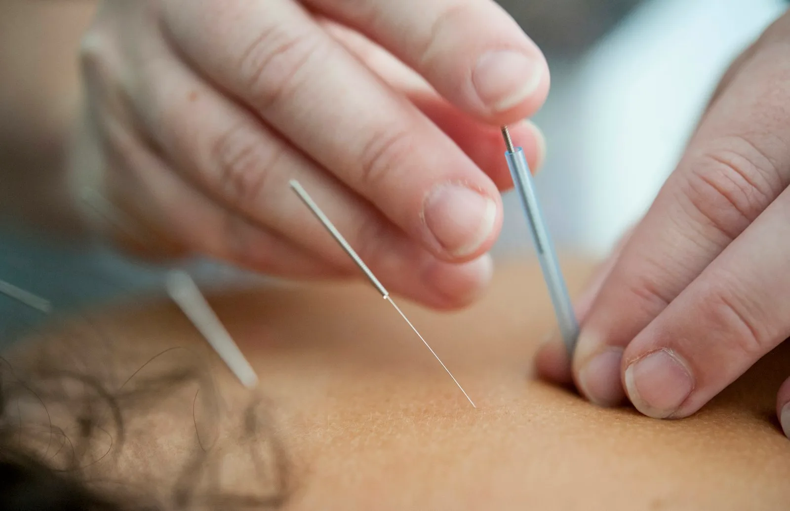 acupuncture and dry needling Mijas Marbella - Costa Health