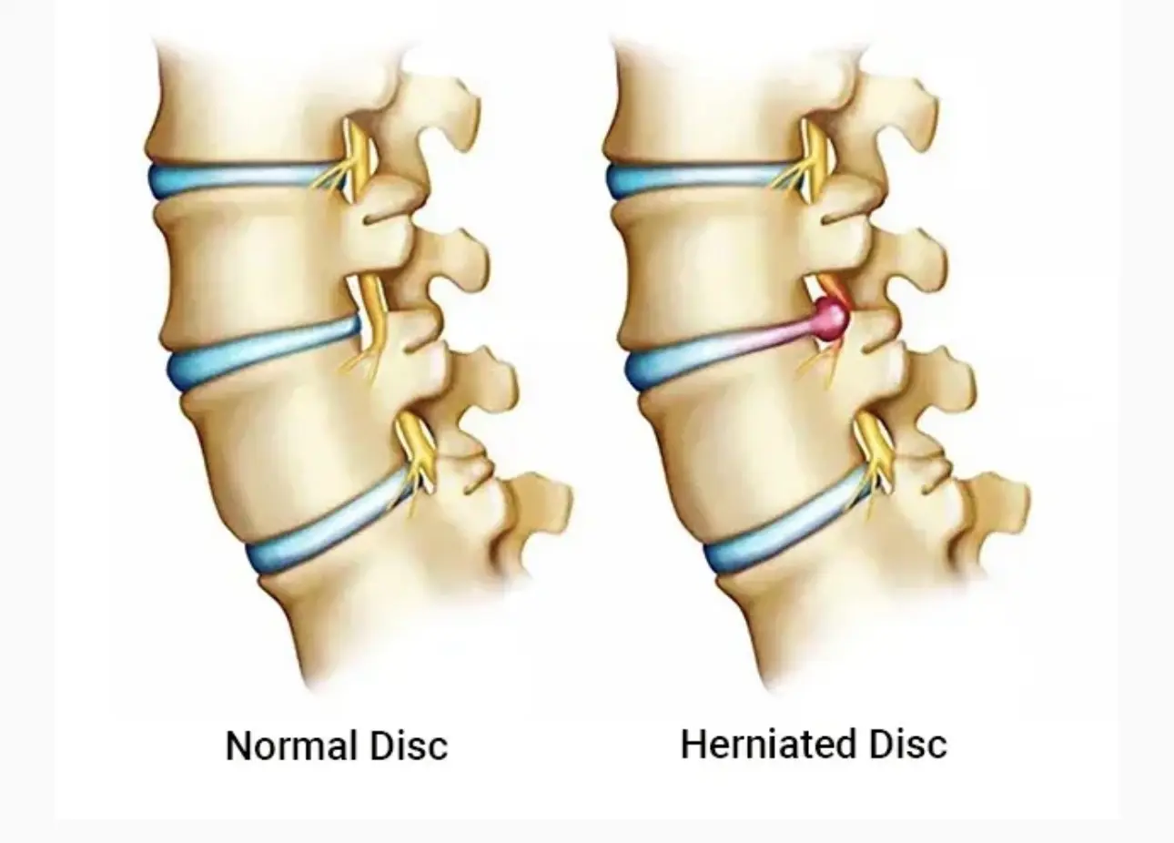 Do Disc Bulges or Herniations Always Need Surgery? A Physiotherapist Explains