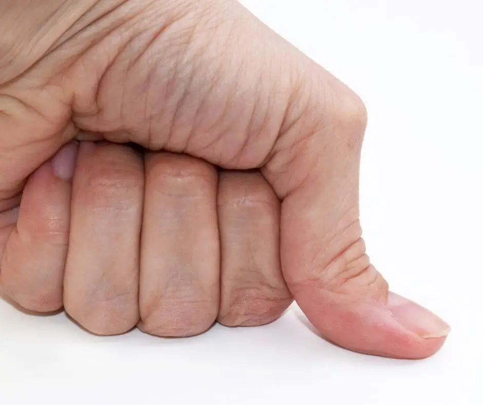 Hypermobility Physiotherapy