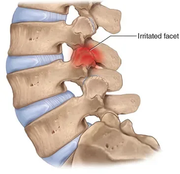 Facet Joint Dysfunction