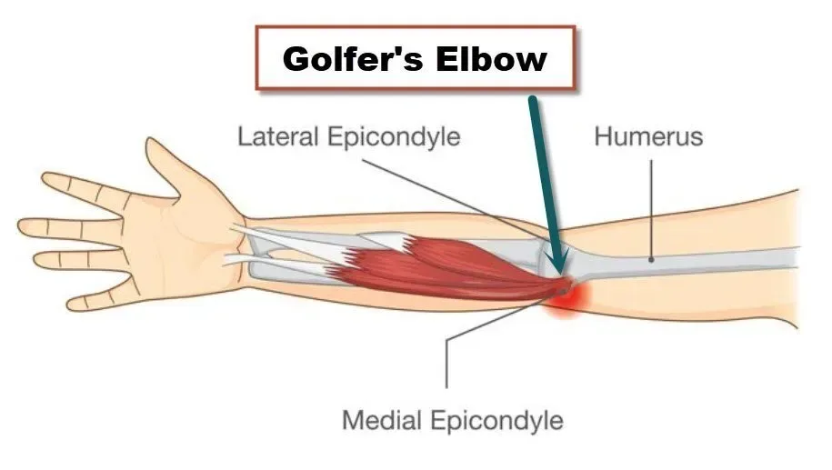 Golfer's Elbow