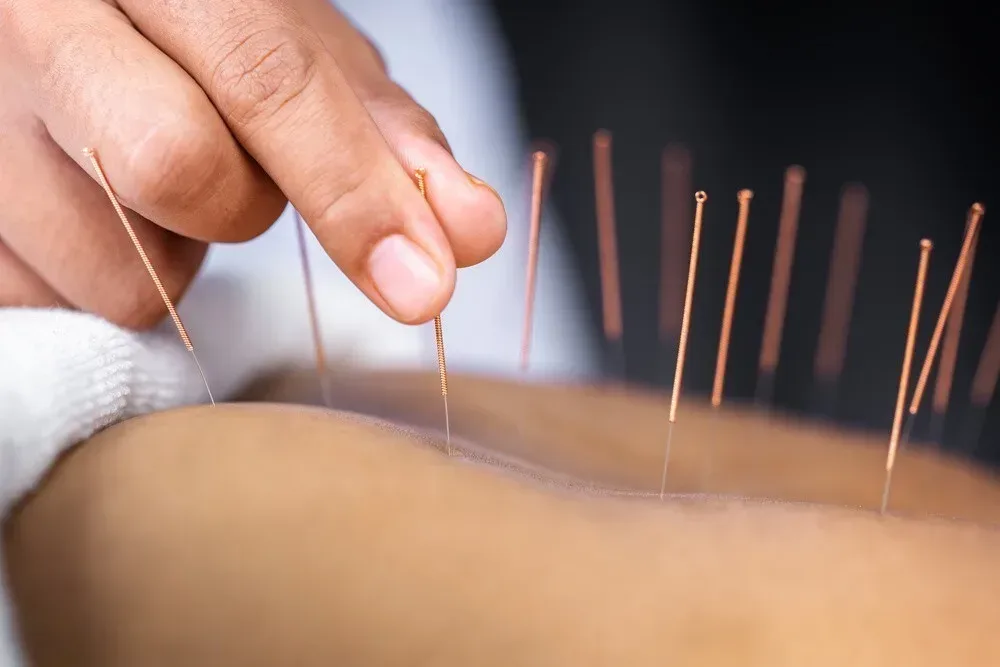 Dry Needling