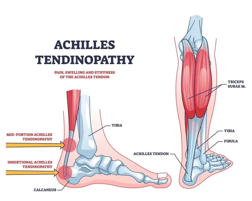 Achilles Tendonitis