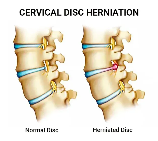 Cervical Disc Herniation