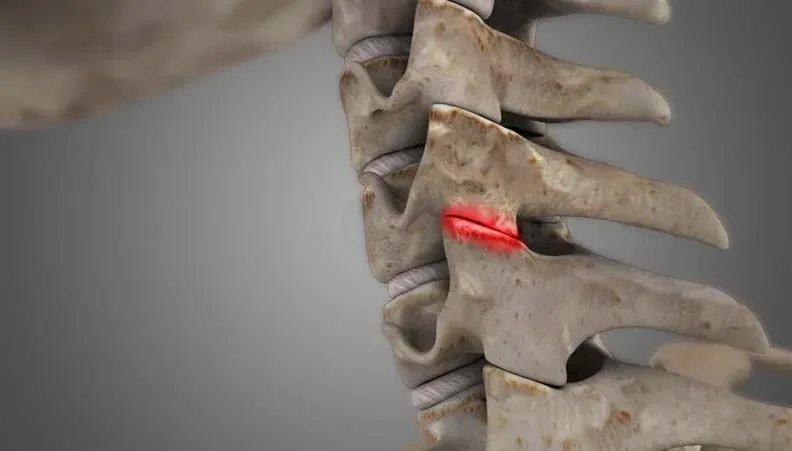 Cervical Facet Syndrome