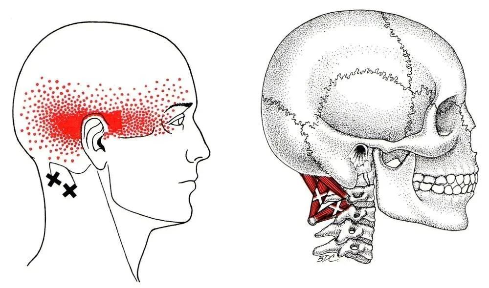 Cervicogenic Headaches