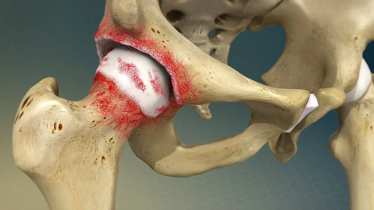 Degenerative Joint Disease of the Hip & Osteoarthritis