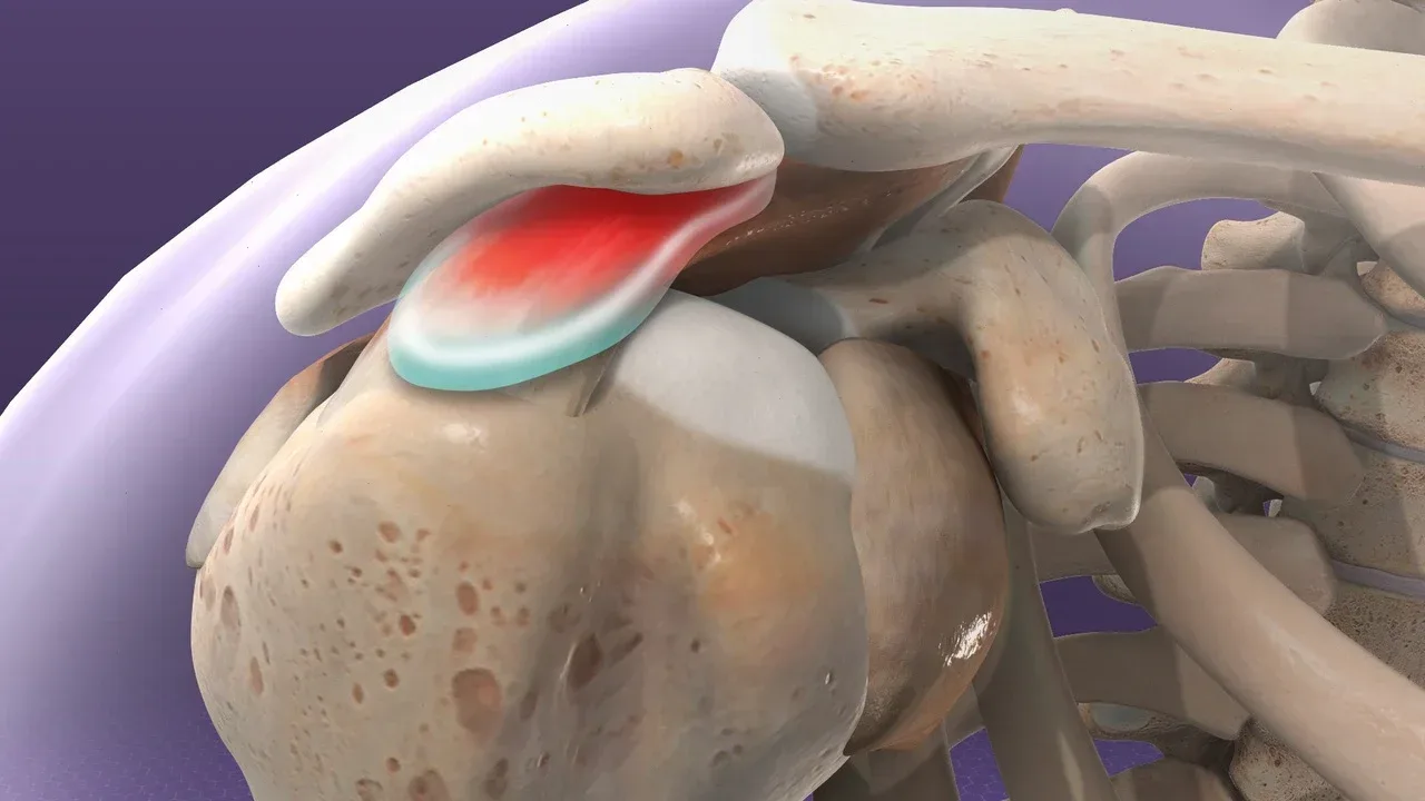 Impingement Syndrome in the Shoulder