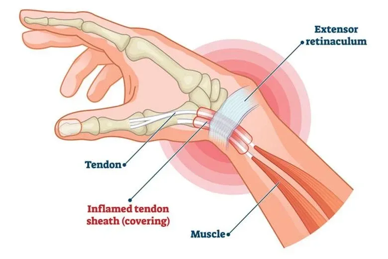 Painful Wrist (De Quervain’s Tenosynovitis)