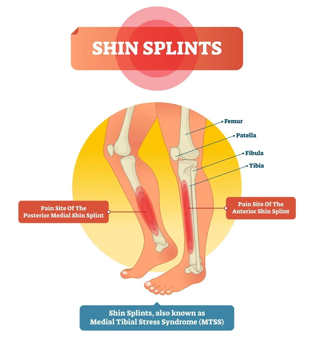 Shin Splints