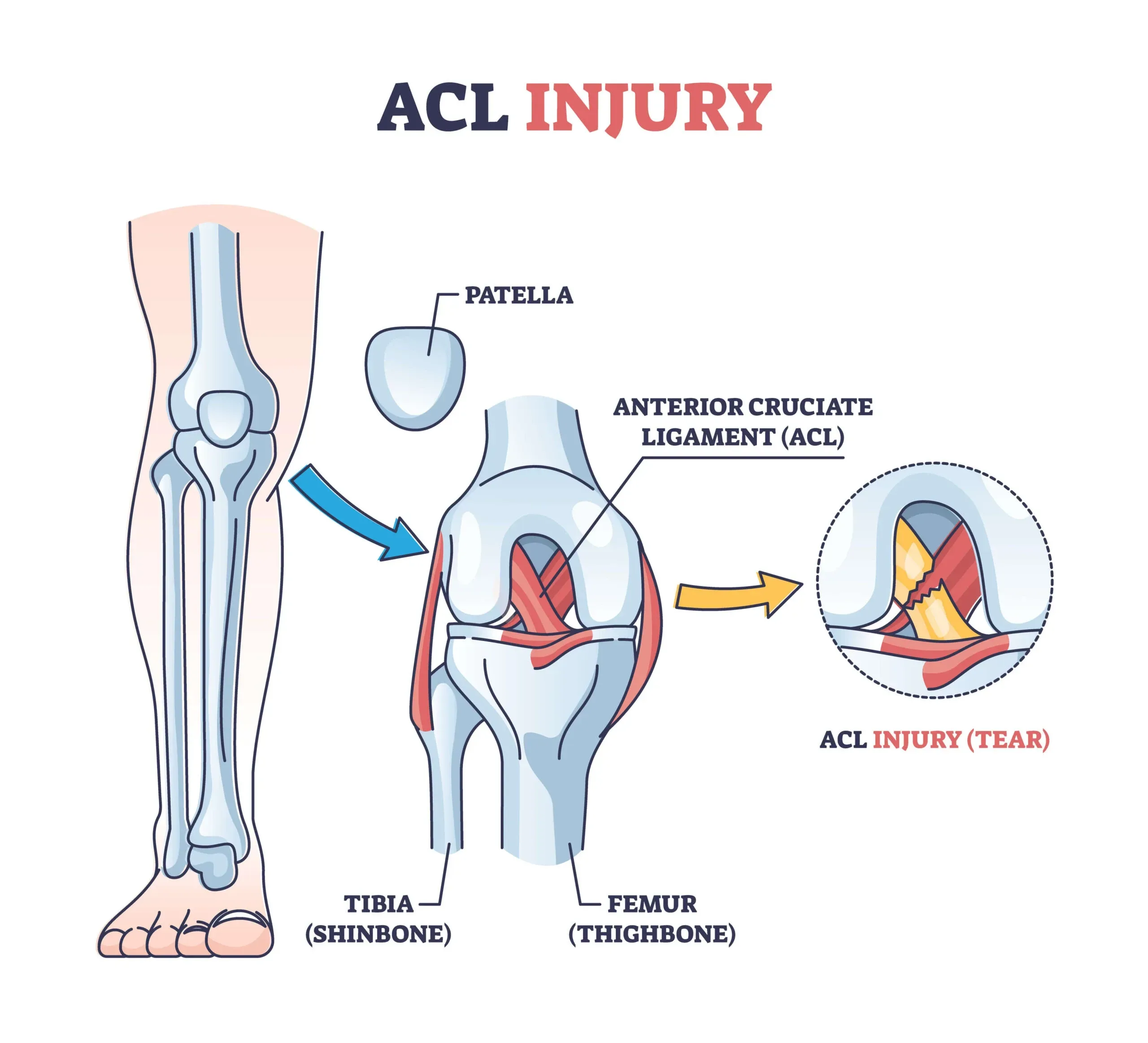 acl injury