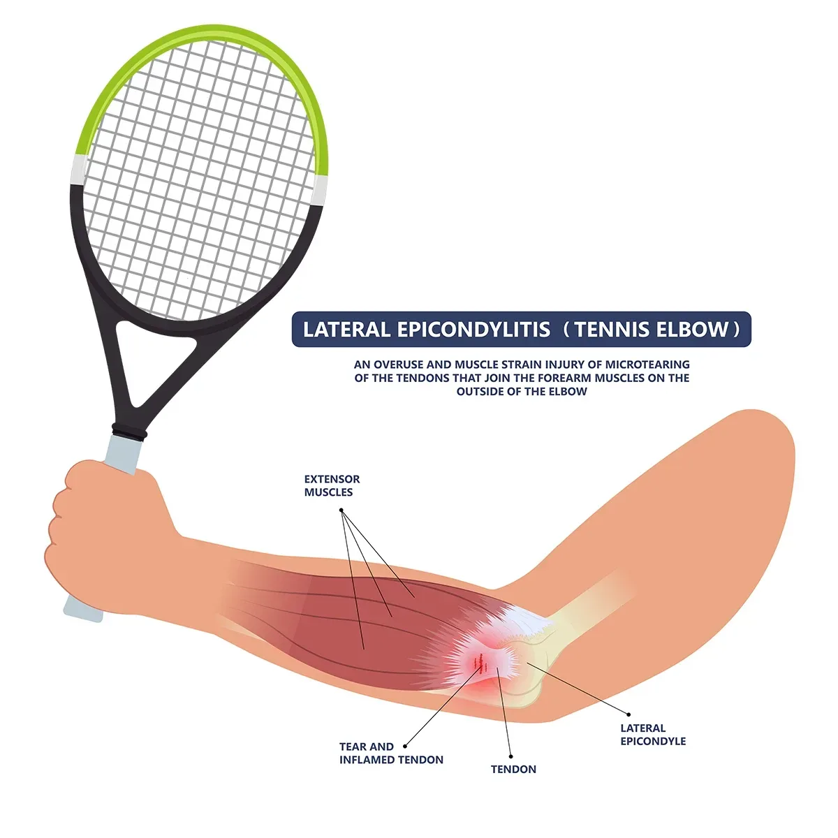 tennis elbow